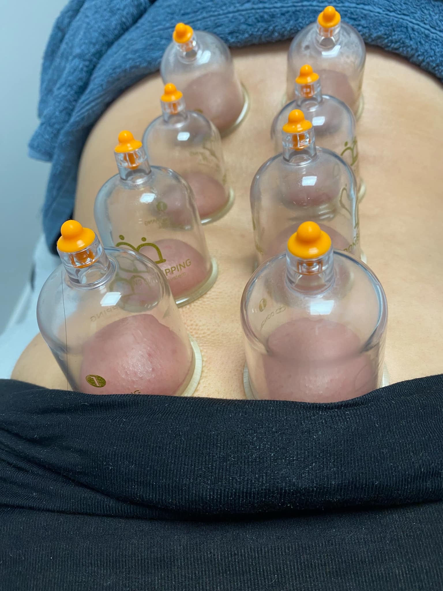 Cupping Therapy